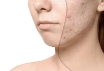 ĐIỀU TRỊ MỤN NÁM SẸO UY TÍN TẠI VẠN PHÚC