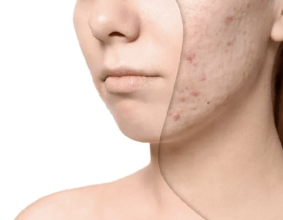 ĐIỀU TRỊ MỤN NÁM SẸO UY TÍN TẠI VẠN PHÚC